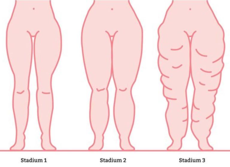 Lipoedeem stadia