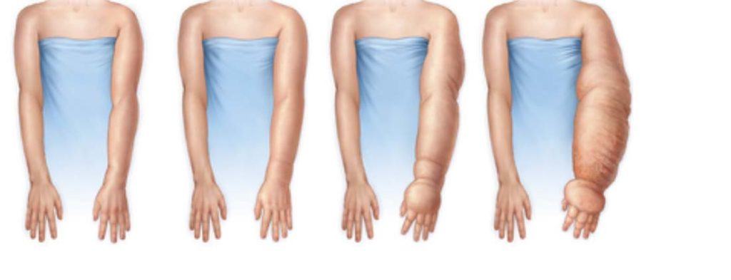 Lymfoedeem stadia armen